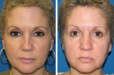 Before & After Photos